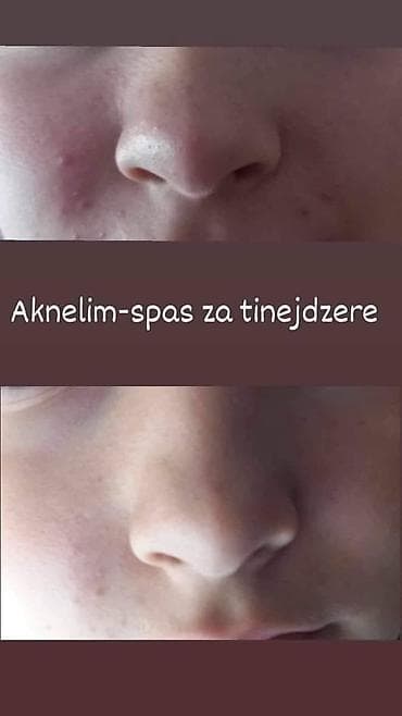 sinsay kožne jakne: Aknelim gel 30ml – 100% delotvoran saveznik protiv akni Iskoristite — 1
