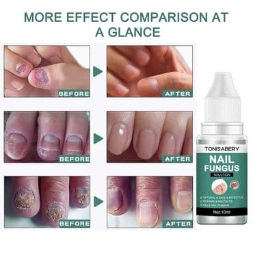 limes za gljivice na noktima: Cena 950 din Serum za uklanjanje gljivica 10ml Protiv infekcija, za — 2