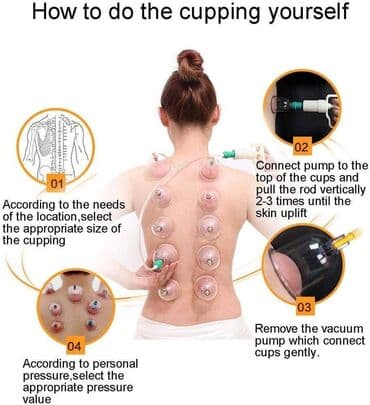 Ventuze . CUPPING-fizikalna terapija-akupunktura- čašama Komplet za — 11