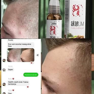 sinsay kožne jakne: Aknelim gel 30ml – 100% delotvoran saveznik protiv akni Iskoristite — 3