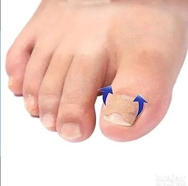 guess torba mala: Flasteri za urasle nokte – korektivne trakice za podizanje ivica nokta — 2