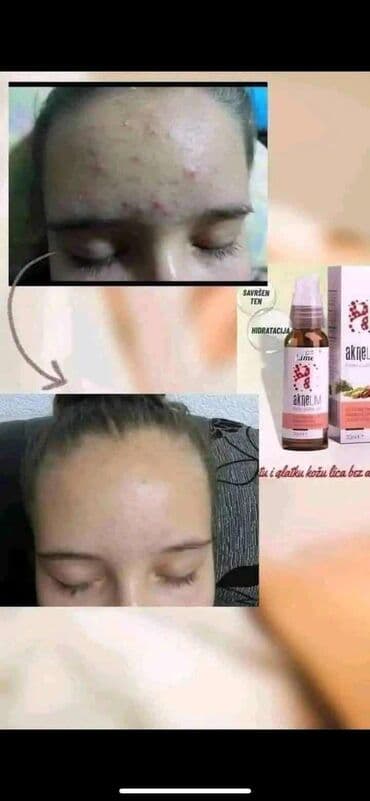 Perfumes: Aknelim gel 30ml – 100% delotvoran saveznik protiv akni Iskoristite — 2