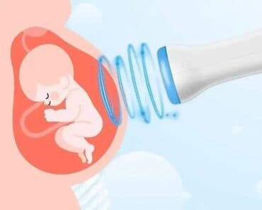 Other medical supplies: Баби ДОППЛЕ Р је један од најсавременијих ултразвучних уређаја ("Фетал — 2