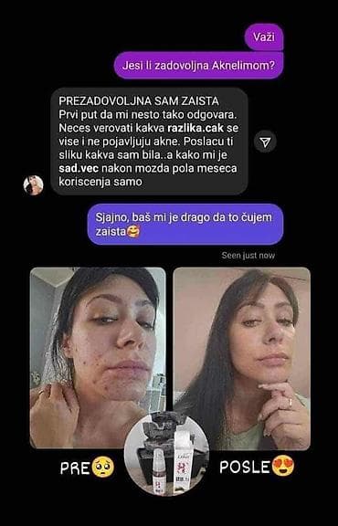 sinsay kožne jakne: Aknelim gel 30ml – 100% delotvoran saveznik protiv akni Iskoristite — 4