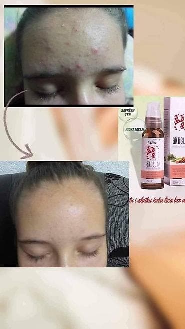 sinsay kožne jakne: Aknelim gel 30ml – 100% delotvoran saveznik protiv akni Iskoristite — 5