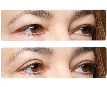 Trakice za korekciju / podizanje očnih kapaka Cena:700din/40kom (20 na lalafo.rs Trakice za korekciju / podizanje očnih kapaka Cena:700din/40kom (20