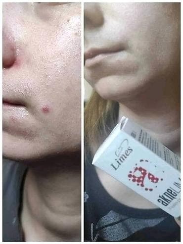 sinsay kožne jakne: Aknelim gel 30ml – 100% delotvoran saveznik protiv akni Iskoristite — 6