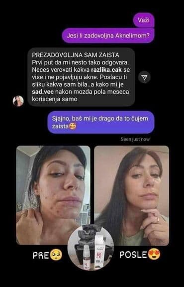 Perfumes: Aknelim gel 30ml – 100% delotvoran saveznik protiv akni Iskoristite — 5