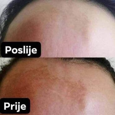 jednodelni skafander za zene: Iskustvo korisnice 🌹 Ovo je moje lično iskustvo sa Limes 21 kremom – — 6