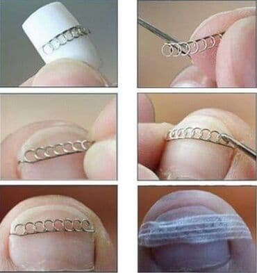 Proteza za urasle nokte Cena: 1100din U pakovanju dobijate 6kom na lalafo.rs Proteza za urasle nokte Cena: 1100din U pakovanju dobijate 6kom