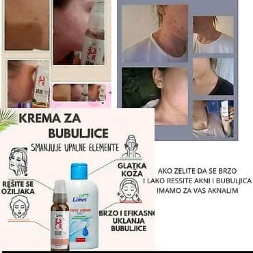 sinsay kožne jakne: Aknelim gel 30ml – 100% delotvoran saveznik protiv akni Iskoristite — 10