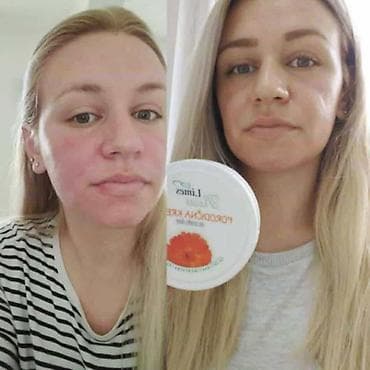 ps bluze i majice: Limes Rosa Porodična krema – kantarion i neven Višenamenska krema za — 3