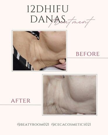 12D HIFU tretman – zatezanje i podmlađivanje vrata i podbratka - na lalafo.rs 12D HIFU tretman – zatezanje i podmlađivanje vrata i podbratka -