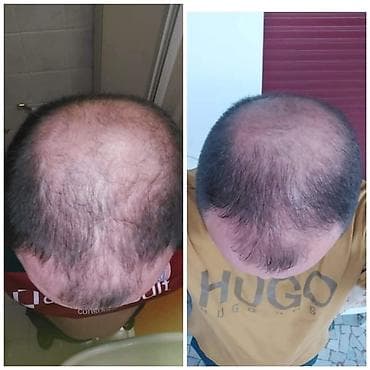 KOSALim – biljni losion za rast kose - Namenjen prorjeđivanju kose i na lalafo.rs — 3 KOSALim – biljni losion za rast kose - Namenjen prorjeđivanju kose i — 3