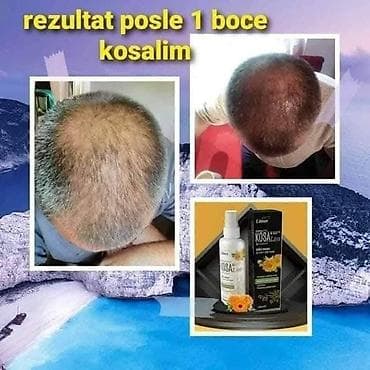 KOSALim – biljni losion za rast kose - Namenjen prorjeđivanju kose i na lalafo.rs — 4 KOSALim – biljni losion za rast kose - Namenjen prorjeđivanju kose i — 4